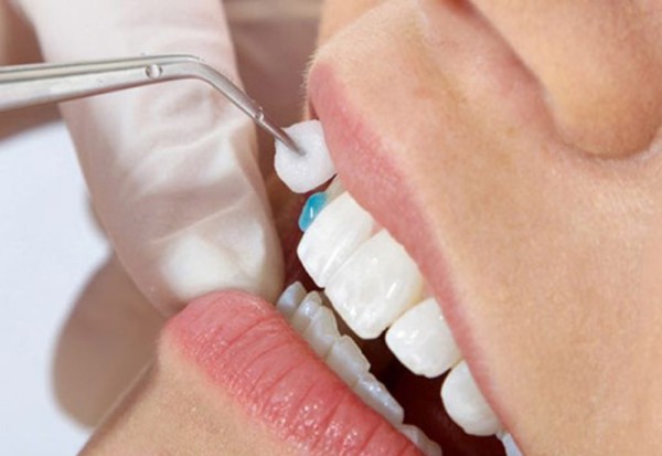 Những lưu ý quan trọng trước và sau khi đắp răng khểnh