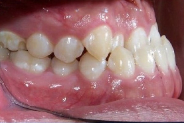 Dấu hiệu nhận biết hàm răng dưới chìa ra ngoài