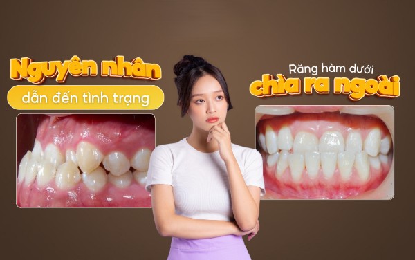 Nguyên nhân gây ra hàm răng dưới chìa ra ngoài