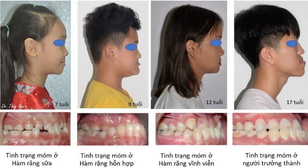 Các loại tình trạng hàm răng dưới chìa ra ngoài