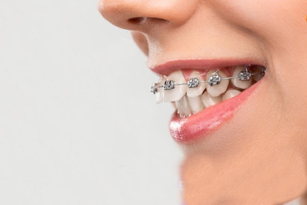 Hô hàm có niềng răng được không?