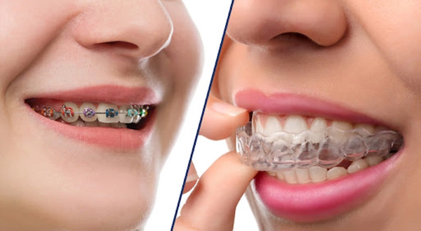 Chi phí và rủi ro khi niềng răng trị hô hàm