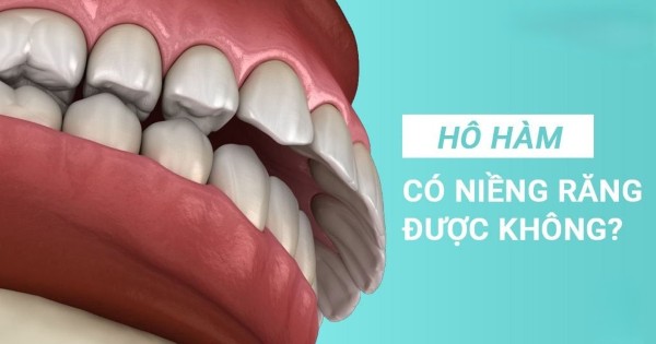 Câu hỏi phổ biến về tình trạng hô hàm có niềng răng được không