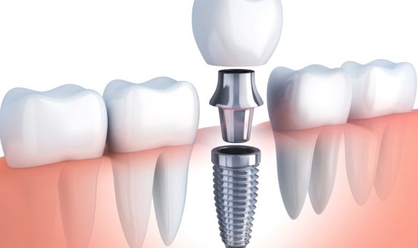 Implant nha khoa là gì?