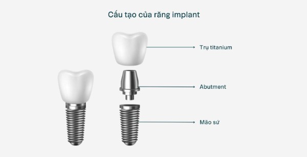 Cấu tạo và vật liệu của implant nha khoa