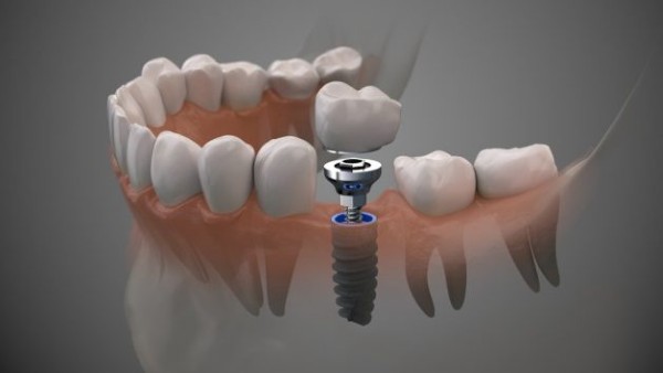 Ưu nhược điểm khi cấy ghép implant nha khoa