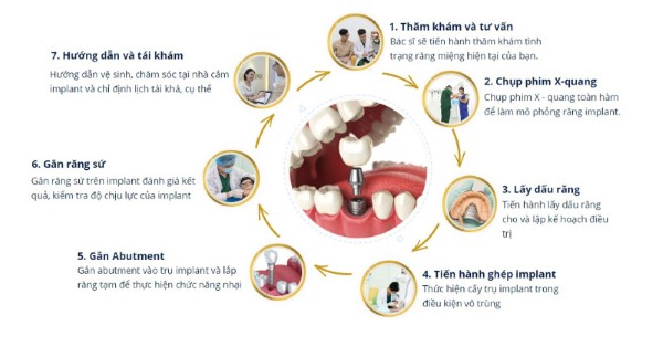 Các bước thực hiện quy trình cấy ghép implant 