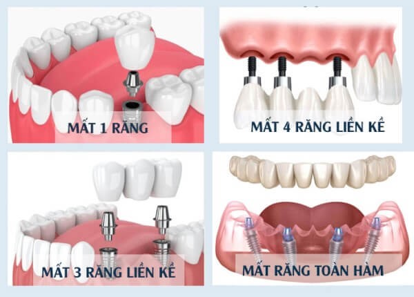Cấy ghép implant có thể áp dụng cho nhiều trường hợp khác nhau