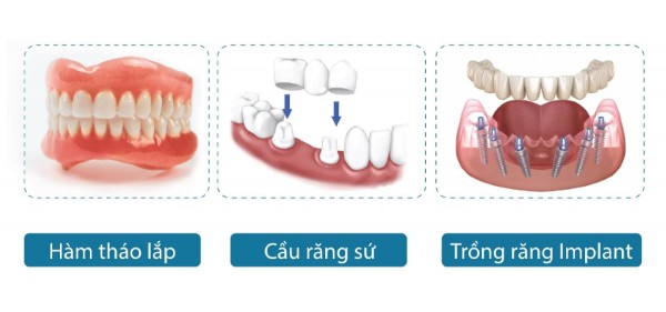 Implant nha khoa so với cầu răng sứ và hàm giả tháo lắp