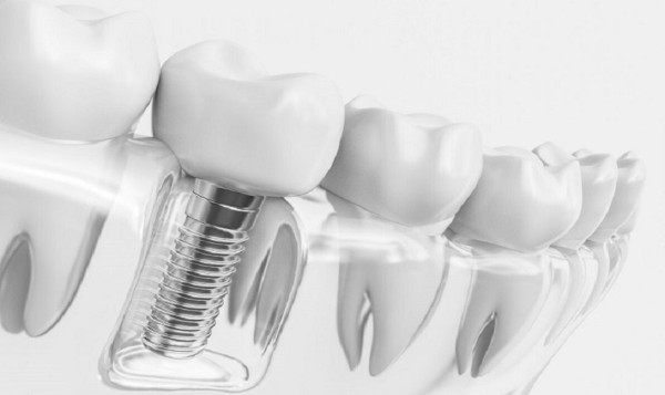 Các câu hỏi thường gặp khi tìm hiểu về implant nha khoa