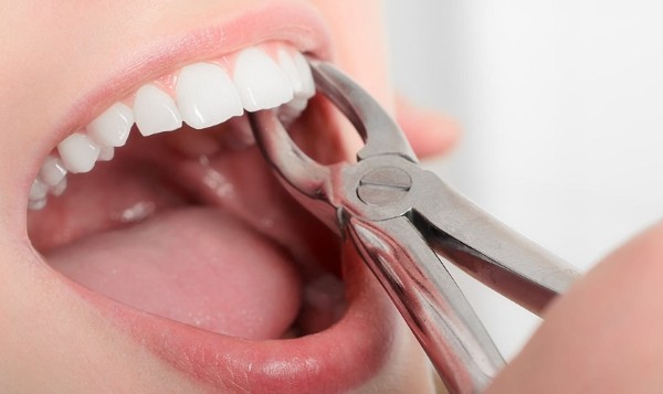Quy trình nhổ răng số 4