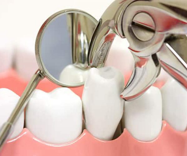 Những lưu ý quan trong và chăm sóc sau khi nhổ răng số 4