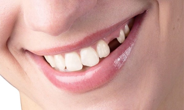 Việc nhổ răng số 4 có thể gây ra một số ảnh hưởng lâu dài đến sức khỏe răng miệng