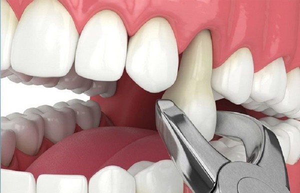 Các câu hỏi thường gặp về nhổ răng số 4 
