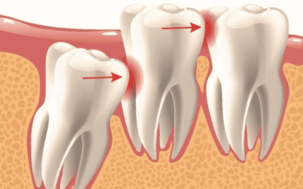 Quá trình mọc của răng 38 được chia thành nhiều giai đoạn khác nhau