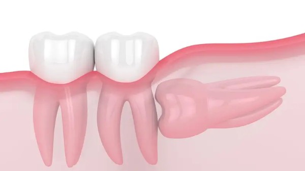 Răng 38 thường gặp vấn đề mọc lệch hoặc ngầm