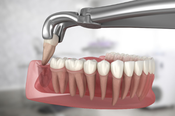 Nhổ răng 38 cần được xem xét kỹ lưỡng dựa trên tình trạng lâm sàng