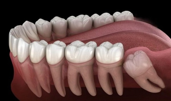Một số câu hỏi thường gặp về răng 38