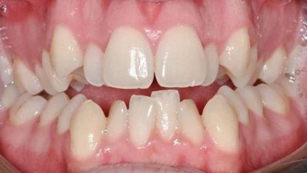 Răng 9630 là thuật ngữ mô tả một dạng lệch lạc trong sự sắp xếp của răng
