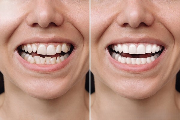 Răng 9630 tác động đến thẩm mỹ và nhiều mặt khác