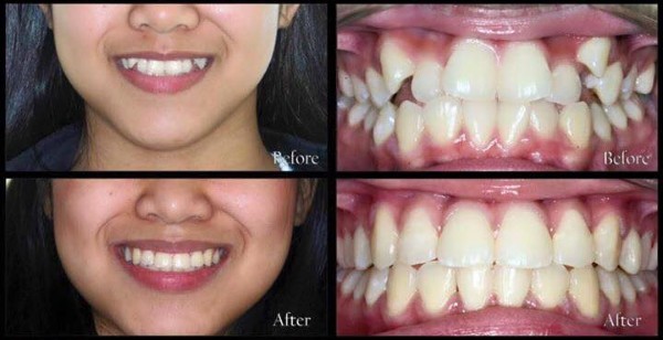 Các phương pháp điều trị cho tình trạng răng 9630