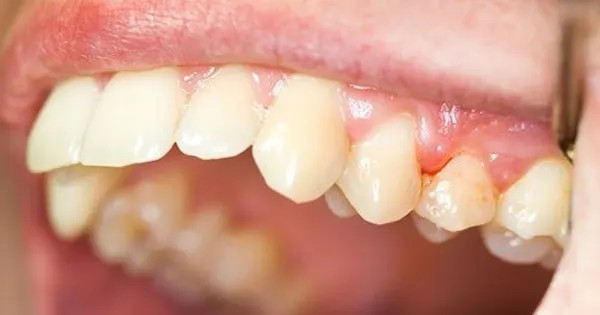 Túi nha chu chính là khoảng trống xuất hiện giữa răng và mô nướu