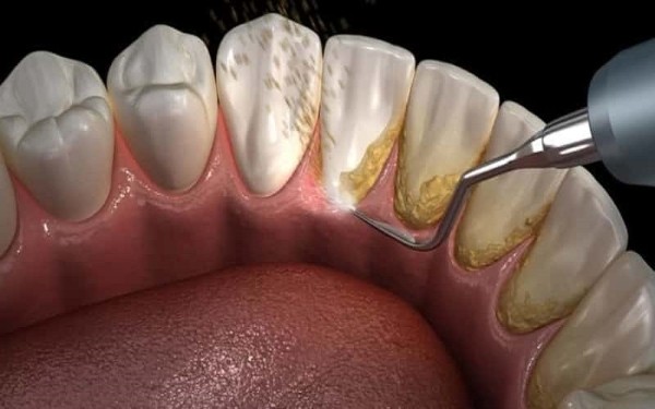 Lấy cao răng để loại bỏ vi khuẩn và mô tổn thương