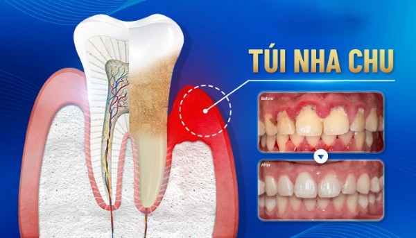 Những câu hỏi thường gặp về túi nha chu