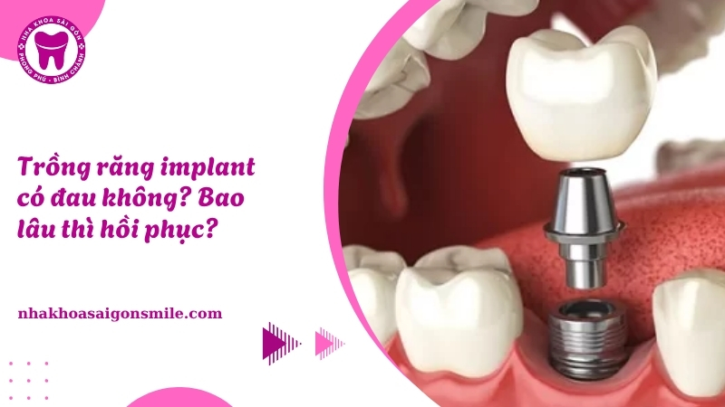 129. Trong rang implant co dau khong Bao lau thi hoi phuc
