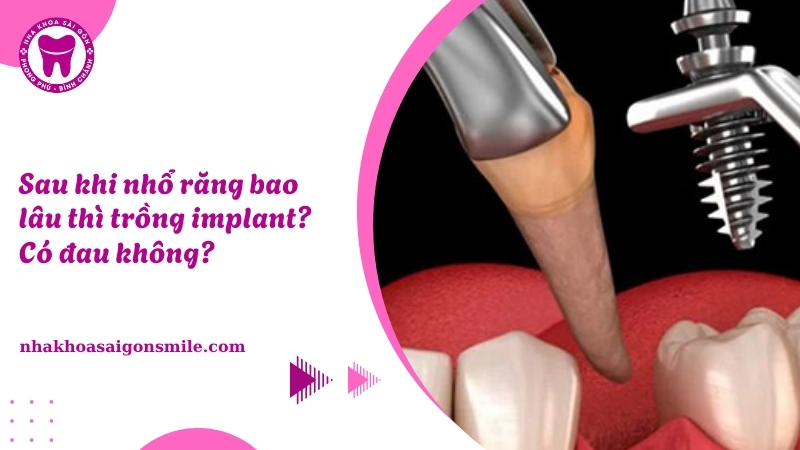 130. Sau khi nho rang bao lau thi trong implant Co dau khong