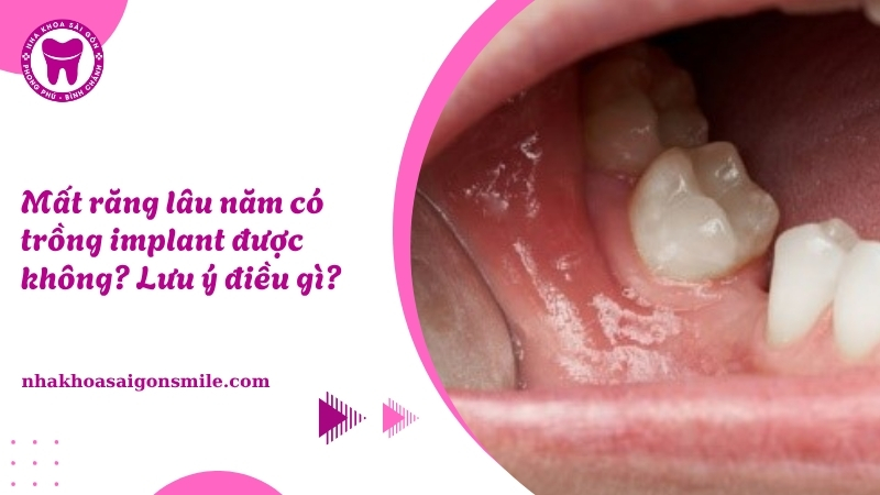 131. Mat rang lau nam co trong implant duoc khong Luu y dieu gi