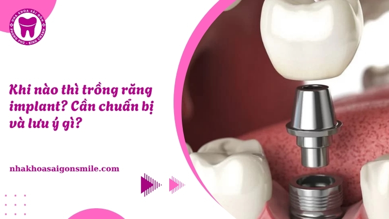 132. Khi nao thi trong rang implant Can chuan bi va luu y gi