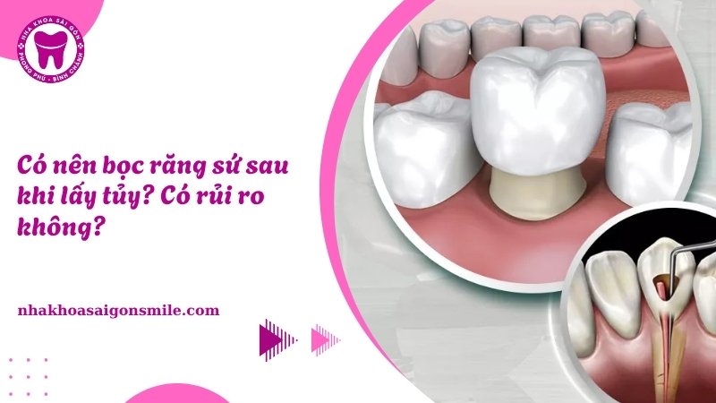 135. Co nen boc rang su sau khi lay tuy Co rui ro khong