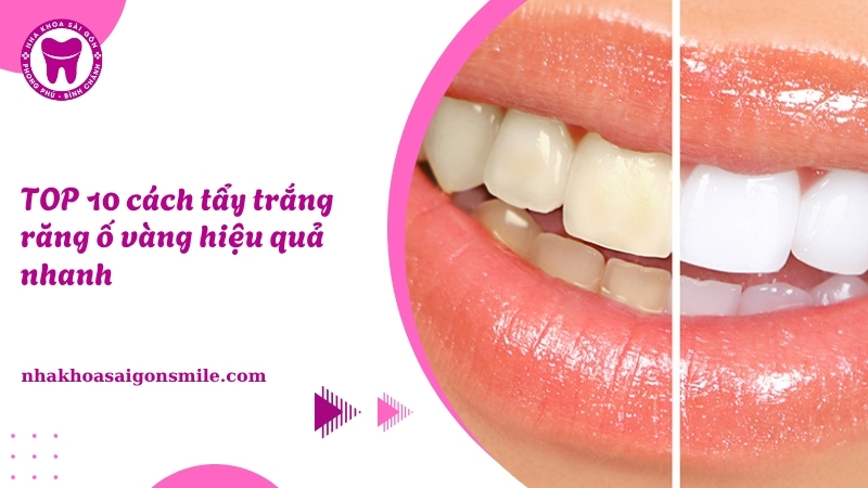 137. TOP 10 cach tay trang rang o vang hieu qua nhanh