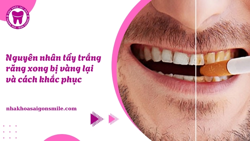 139. Nguyen nhan tay trang rang xong bi vang lai va cach khac phuc