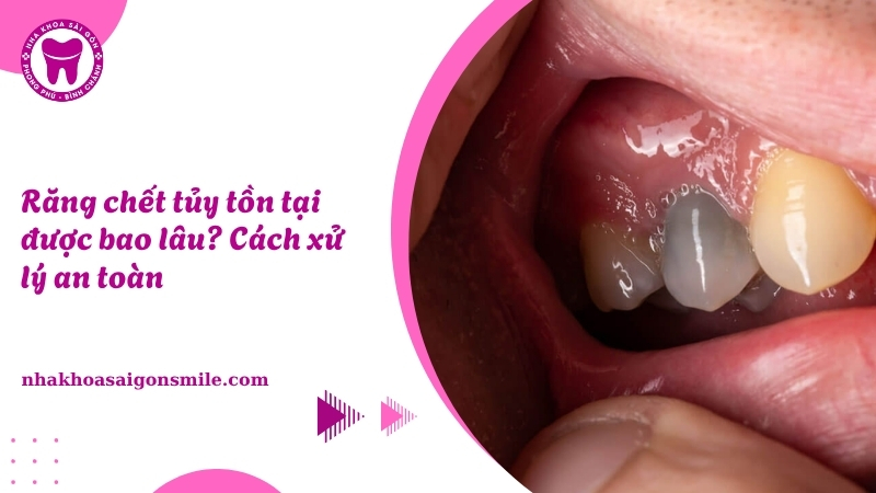 148. Rang chet tuy ton tai duoc bao lau Cach xu ly an toan