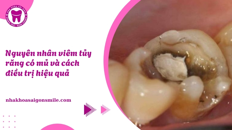 151. Nguyen nhan viem tuy rang co mu va cach dieu tri hieu qua