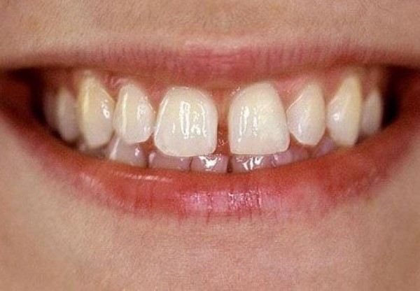 Tình trạng 2 răng cửa bị hô