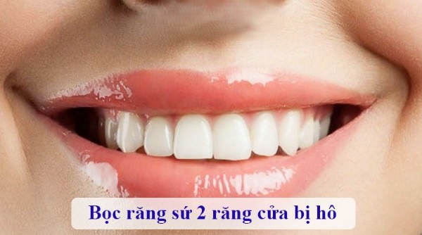 Bọc răng sứ 2 răng cửa bị hô khi răng bị hô nhẹ