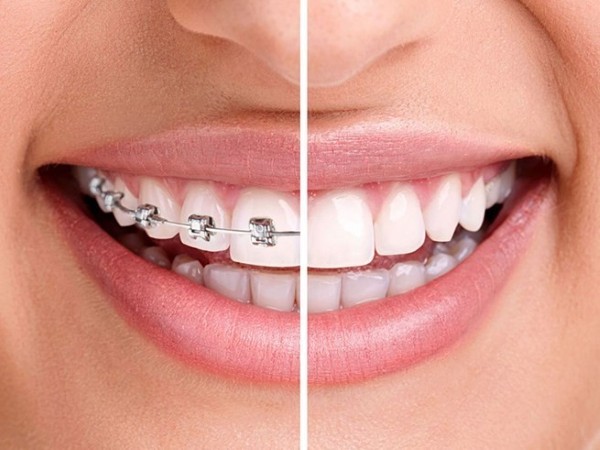 Bọc răng sứ 2 răng cửa bị hô so với niềng răng chỉnh nha
