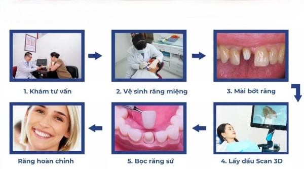 Quy trình bọc răng sứ 2 răng cửa bị hô
