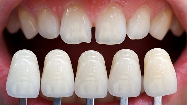 Lựa chọn loại răng sứ phù hợp cho 2 răng cửa