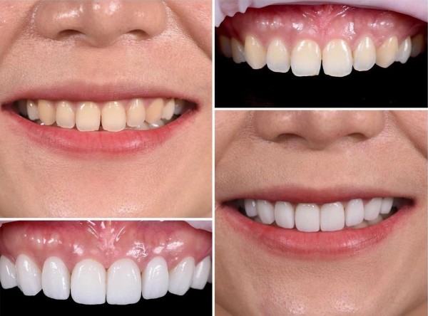 Lợi ích và giới hạn khi bọc răng sứ 2 răng cửa bị hô 