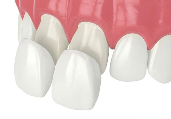 Các câu hỏi thường gặp về bọc răng sứ 2 răng cửa bị hô