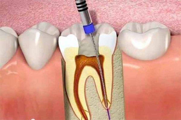 Răng lấy tủy là gì? 