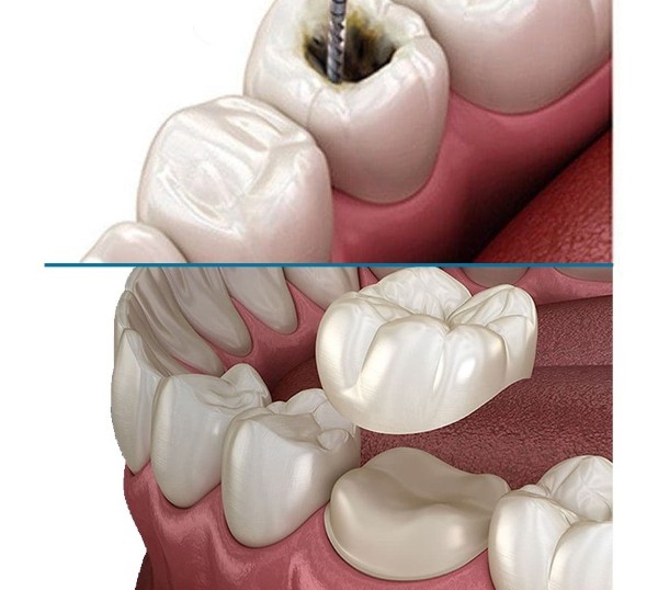 Vai trò của việc bọc răng sứ đối với răng đã lấy tủy