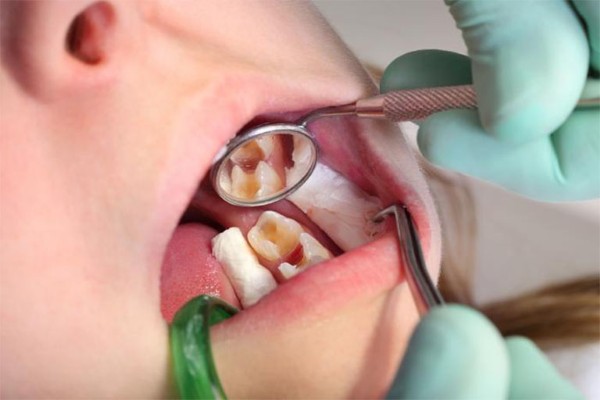 Lấy tủy không cần bọc sứ khi răng còn nguyên mô, ít bị tổn thương, không chịu lực lớn