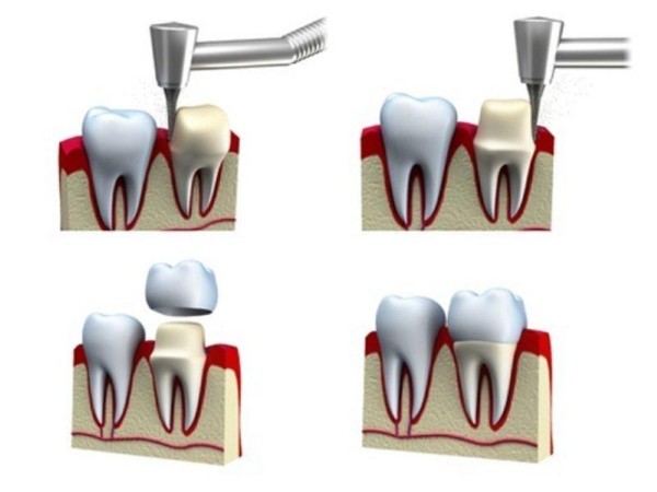 Quy trình bọc răng sứ cho răng đã lấy tủy