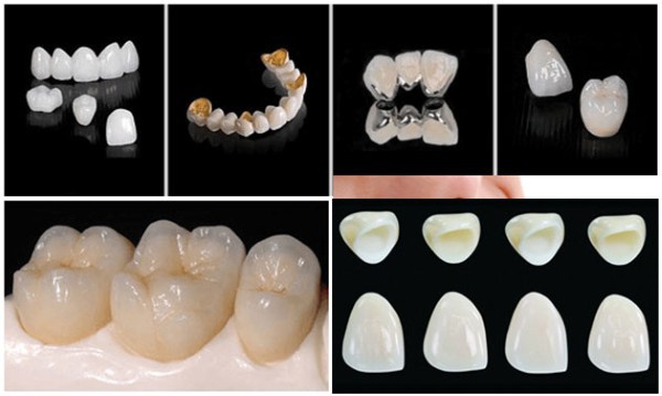 Các loại răng sứ thường dùng cho răng đã lấy tủy
