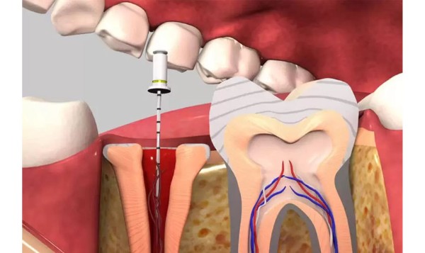 Các câu hỏi thường gặp về có nên bọc răng sứ sau khi lấy tủy